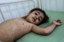 مرض الفقاع الشائع يهدد حياة الفلسطينيين في غزة