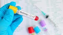 كل ما تريد معرفته عن فيروس "ماربورغ" الخطير
